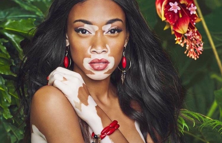 Read more about the article Winnie Harlow  – naujas  „Victoria’s Secret“ modelis